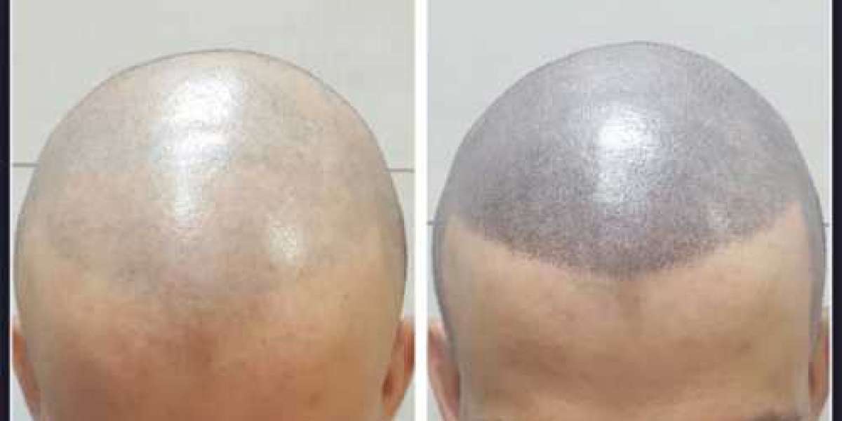 How much is scalp micropigmentation