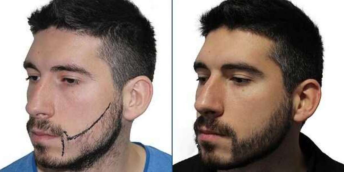 Beard transplant cost