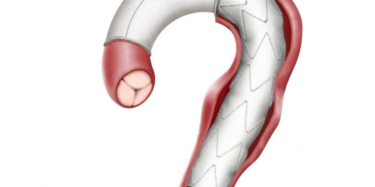 Aorta Vascular Prosthesis Market Growth Statistics, Size Estimation, Emerging Trends, Outlook to 2030