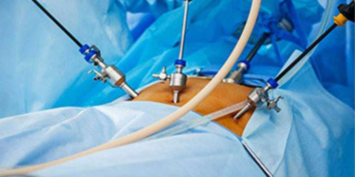 What is an abdominal laparoscopy?