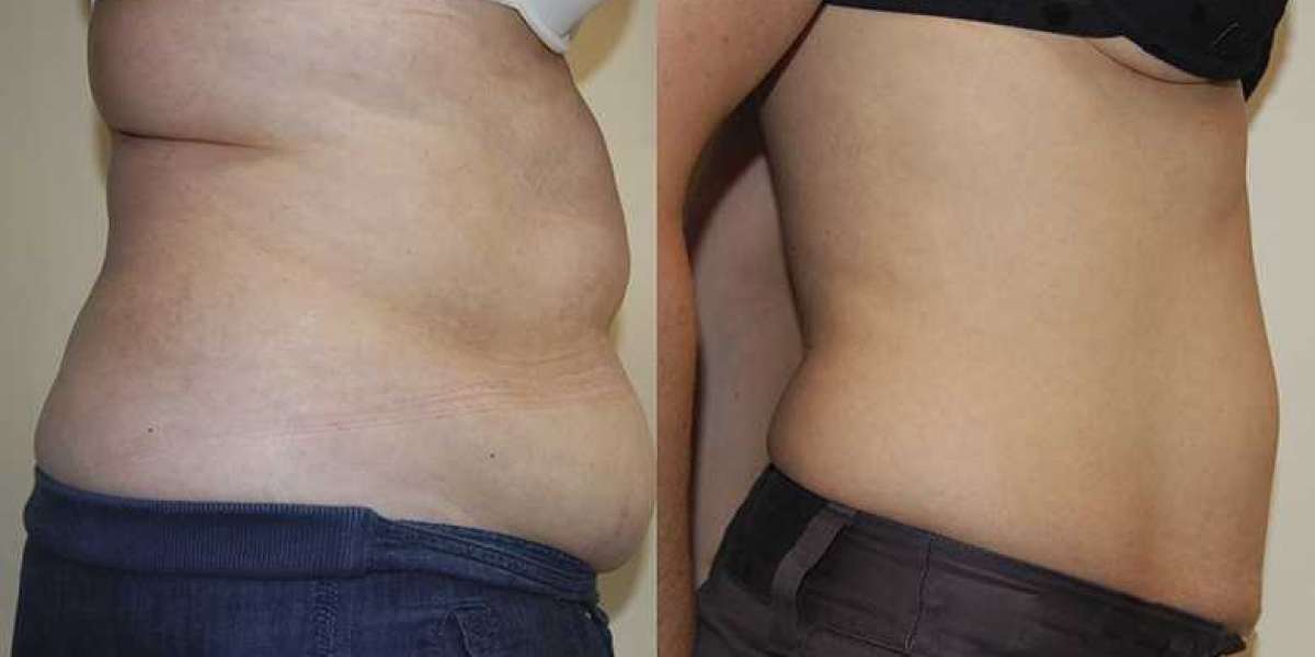 SmartLipo Services in Los Angeles - Your Ultimate Guide to Achieving a Slim and Toned Body: