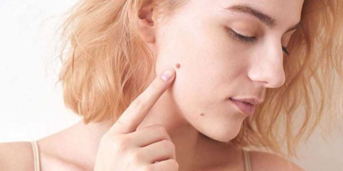 Coneflower Skin Tag Removal (Scam Or Trusted) Beware Before Buying