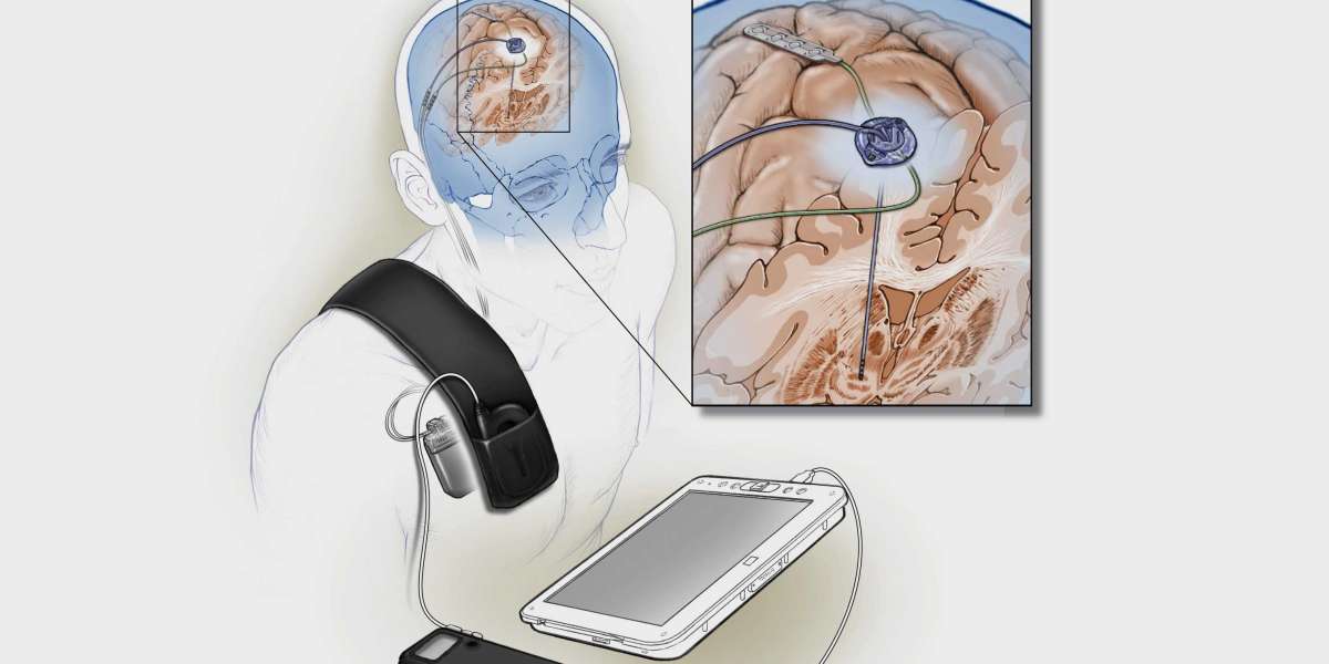 Deep Brain Stimulation Devices Market Worth US$ 3033.4 million by 2030