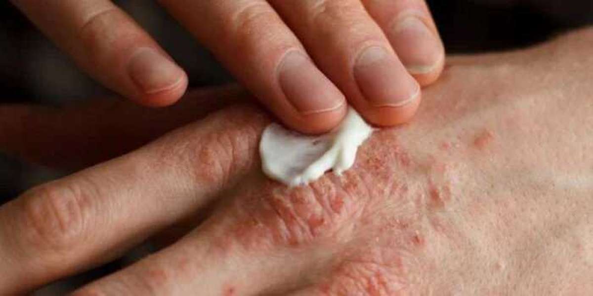 Overcoming Psoriasis with Cutting-Edge Treatments in Surat
