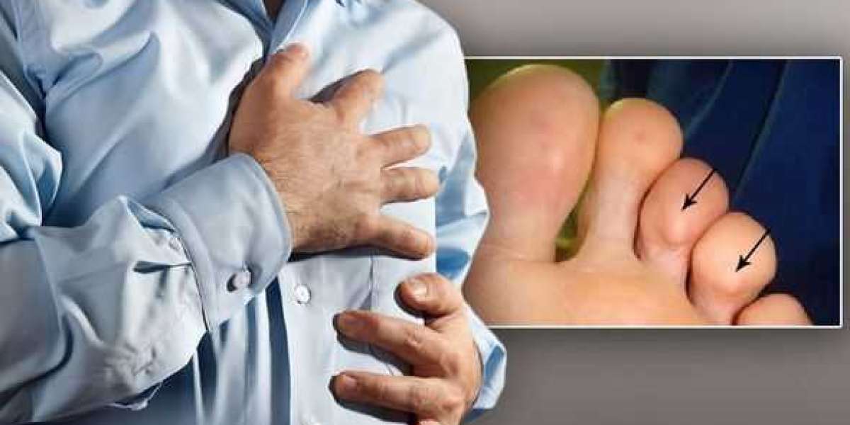 What Are the 4 Stages to a Heart Attack Toe?