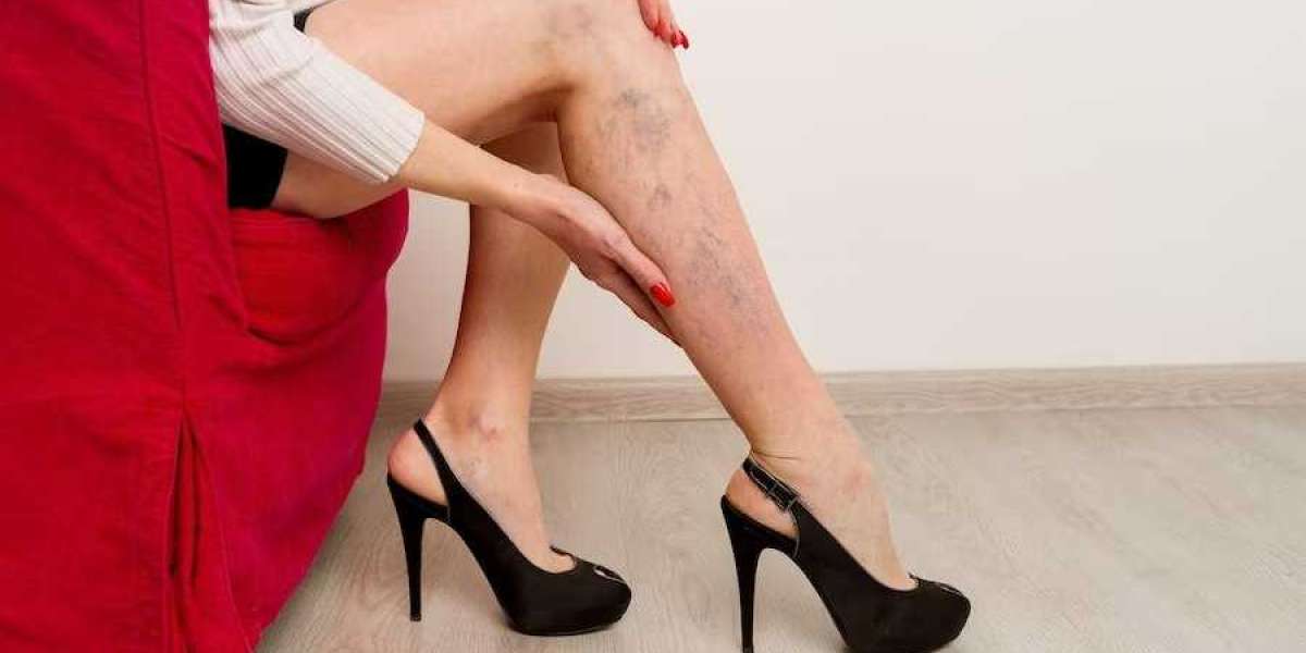 Leg Vein Treatment Options: What Are Your Choices?