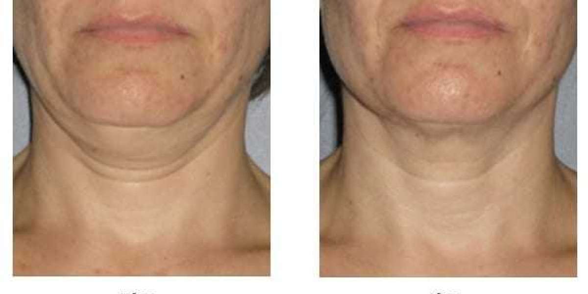 Do You Want To Know How To Loose Neck Fat?