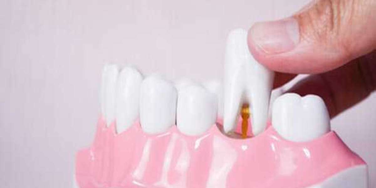 Get Safe And Professional Wisdom Tooth Extraction