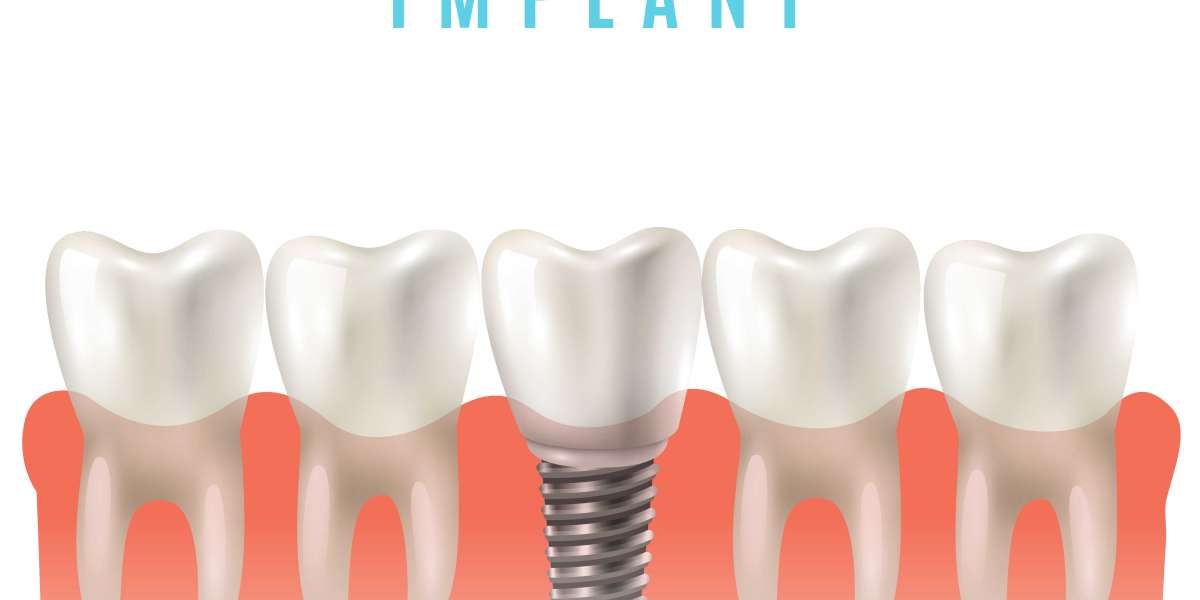 Dental Implants for Seniors: A Solution to Age-Related Tooth Loss