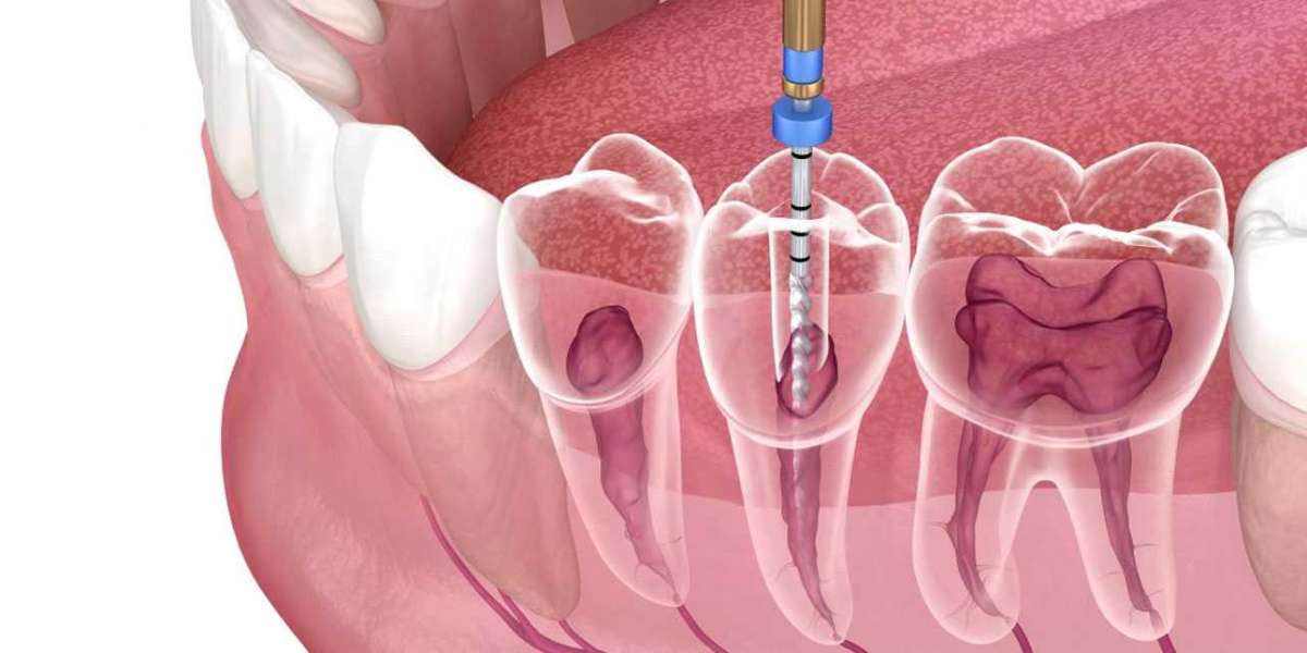 구르가온의 근관 치료 및 치과 임플란트에 대한 이해하기