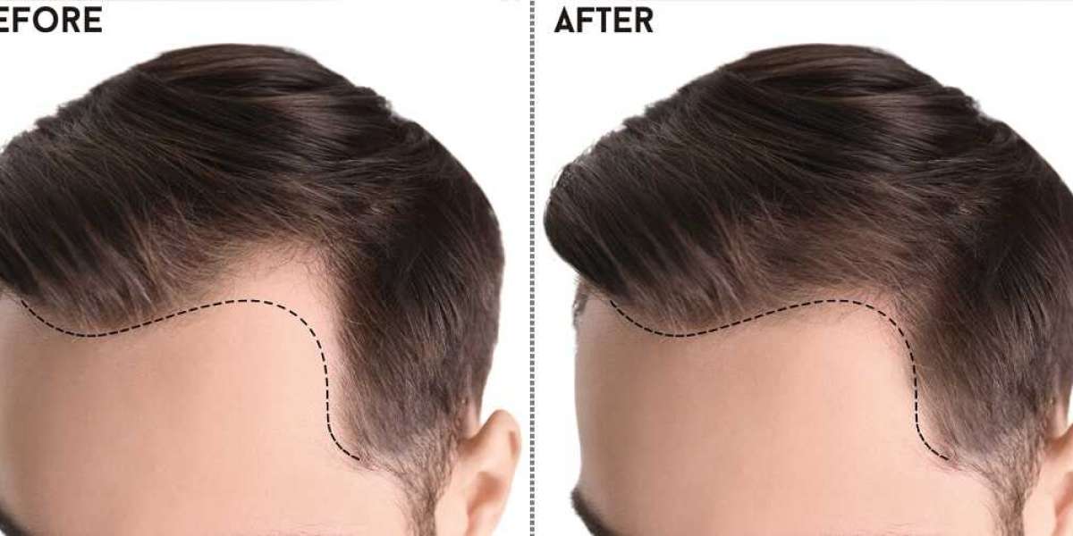 The Revolution in Hair Restoration: Sapphire FUE Hair Transplant in Islamabad