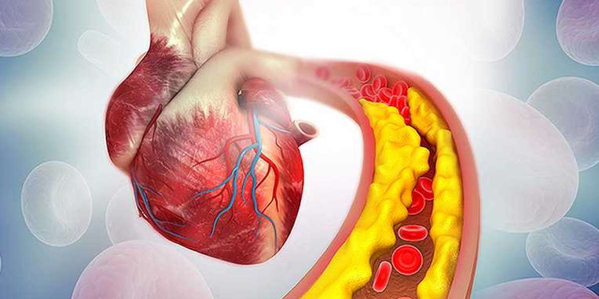 Atherosclerosis Market Size, Growth, Report, Overview & Trends
