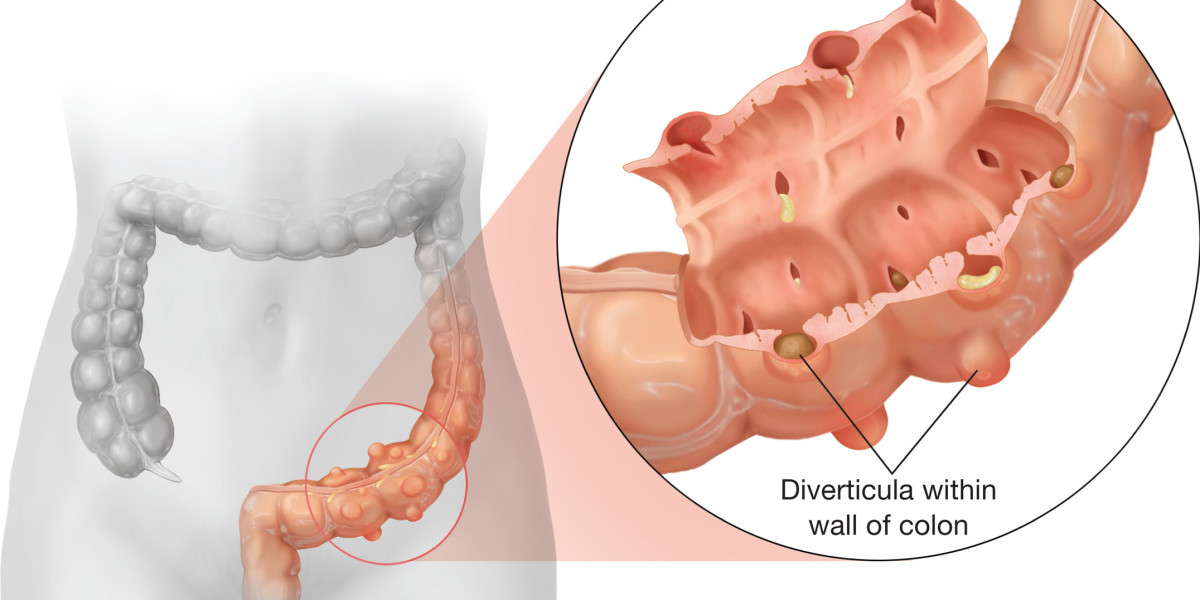 Navigating Diverticulitis: Market Analysis and Research Outlook | DLI