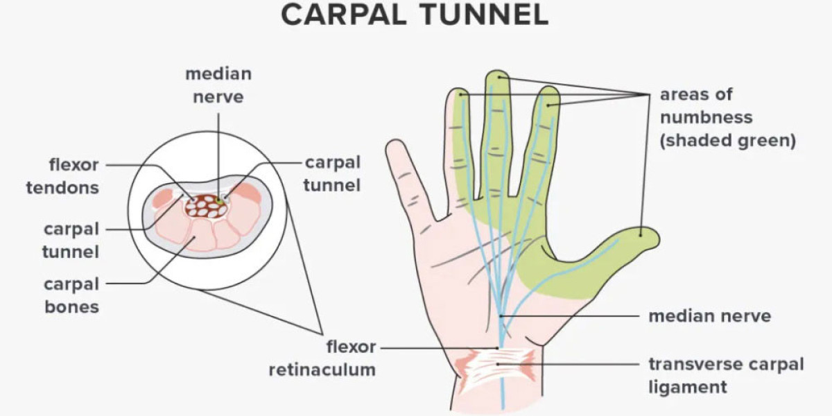 Preventing Carpal Tunnel Syndrome: Strategies for a Pain-Free Future | DLI