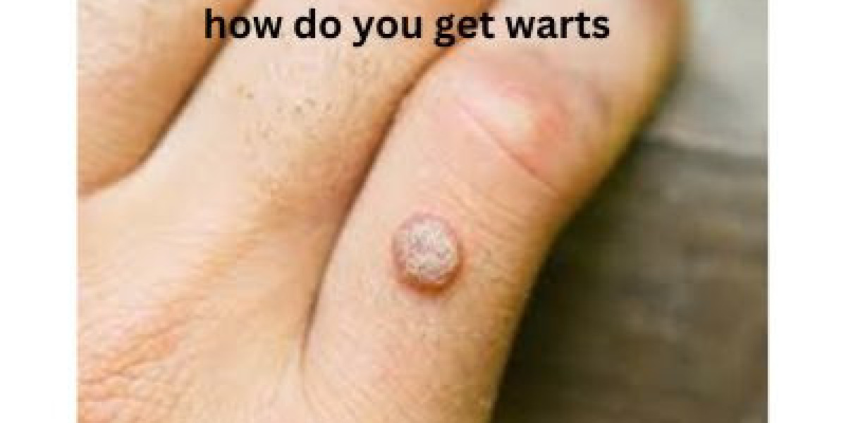 Understanding Warts: Causes, Types, and Prevention