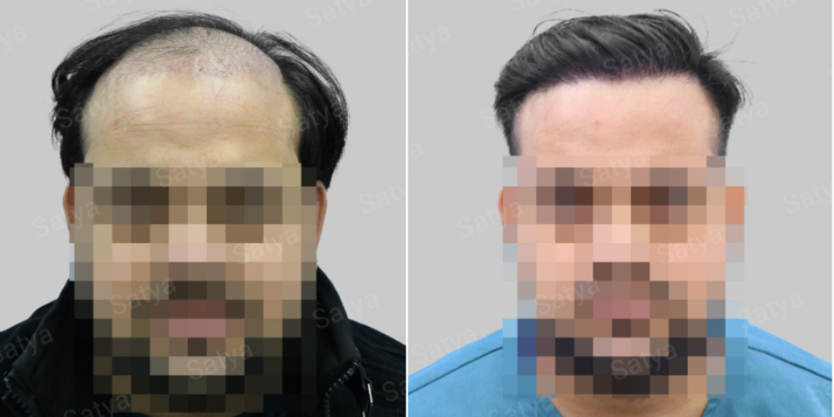 The Future of Confidence with Synthetic Hair Transplant