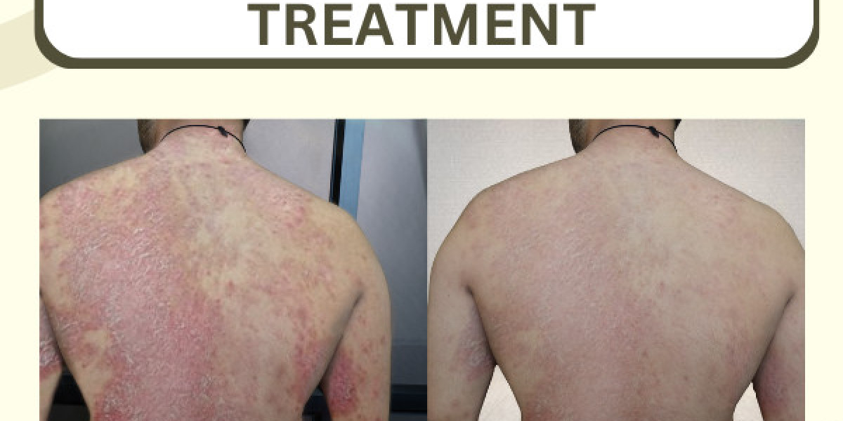 Homeopathic treatment for psoriasis in india
