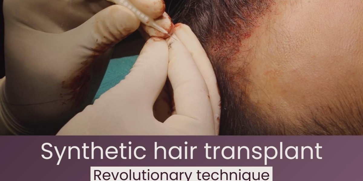Synthetic Hair Transplant: A Breakthrough in Hair Restoration