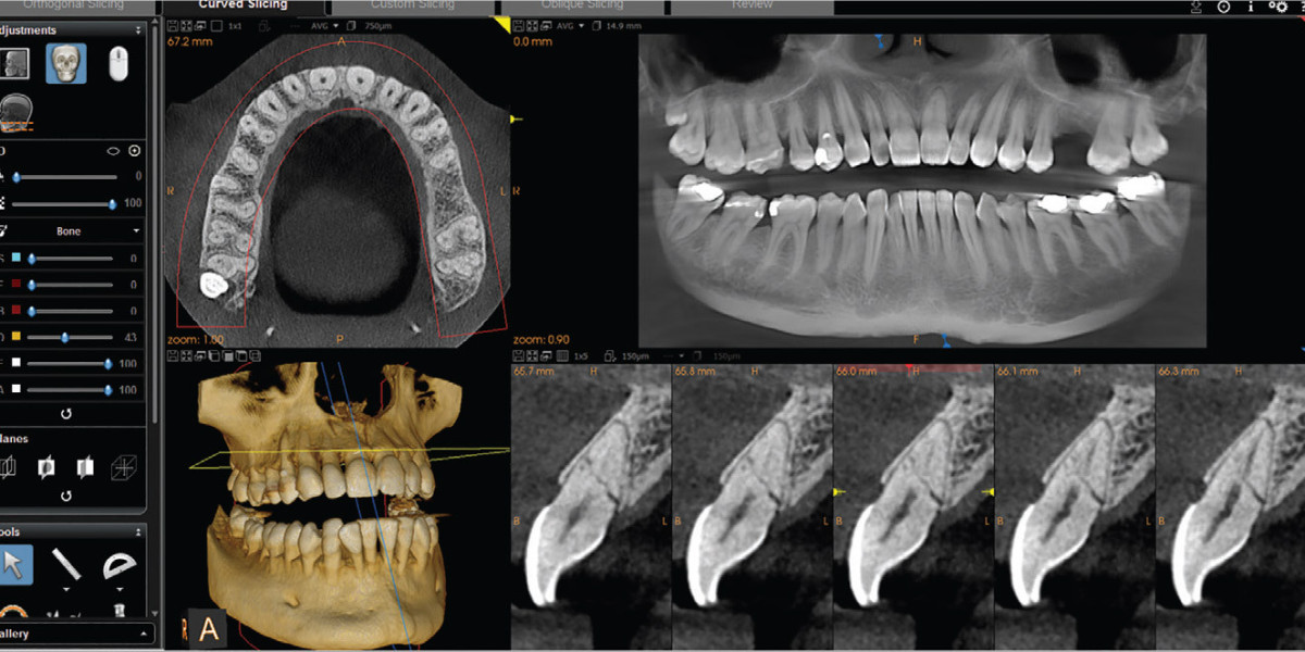 CBCT Dental Imaging Market Insights, Trends, and Outlook