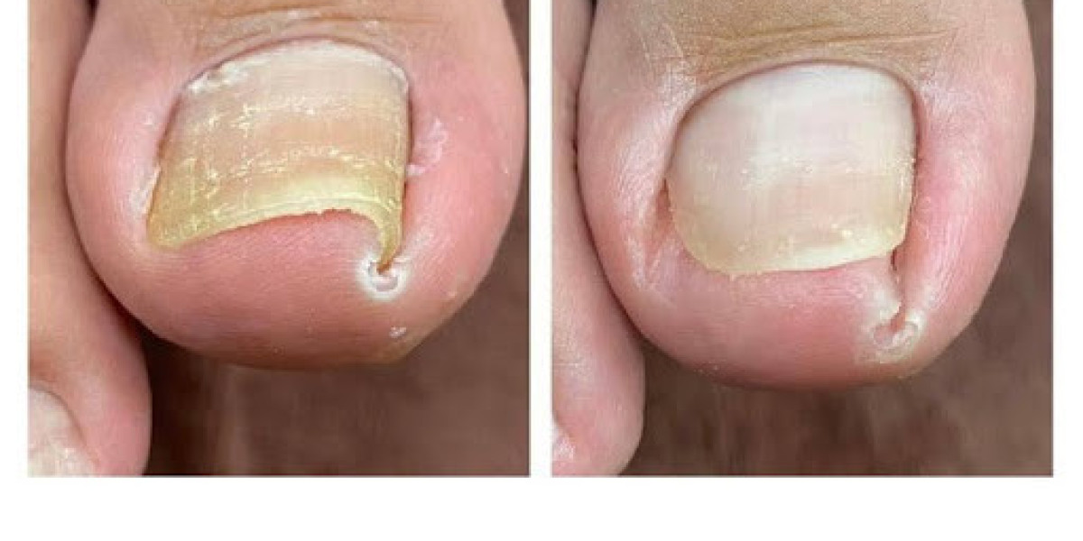 Where to Find Expert Permanent Toenail Removal Services in Arizona?