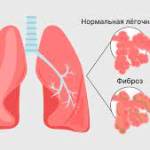 Pulmonary Fibrosis Profile Picture