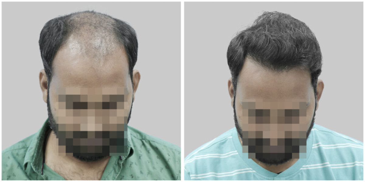 Unlocking Confidence: Hair Transplants in Gurgaon and Delhi