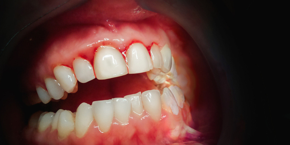 Dispelling 5 Root Canal Treatment Misconceptions