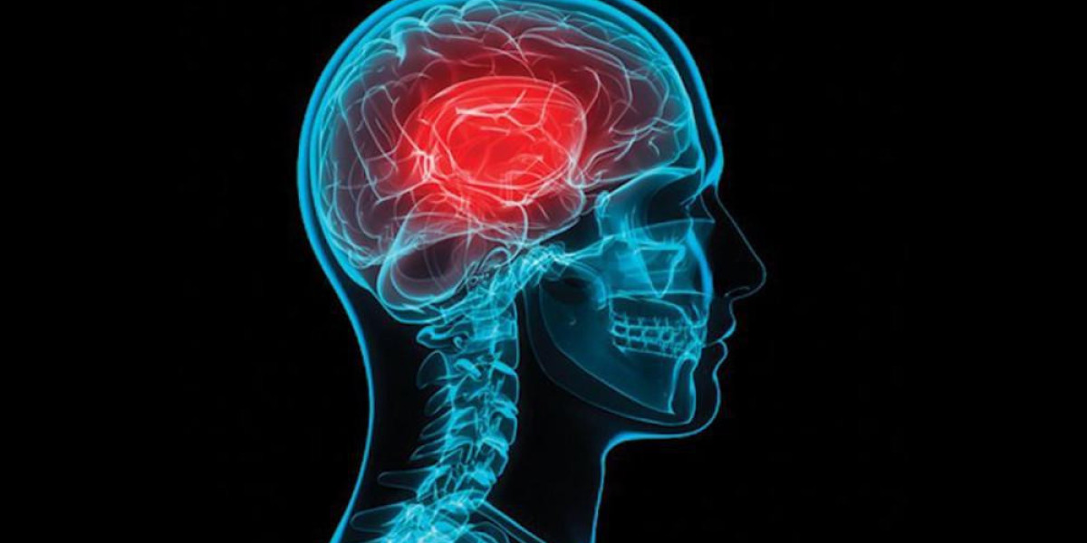 2024, Concussions Market | Industry Analysis Till 2034