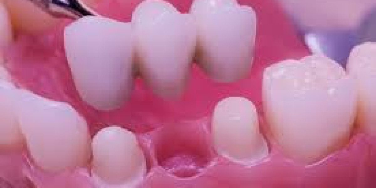 Understanding the Role of Dental Bridges in Restoring Missing Teeth